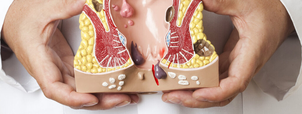 Visita proctologica come prevenire e curare le emorroidi